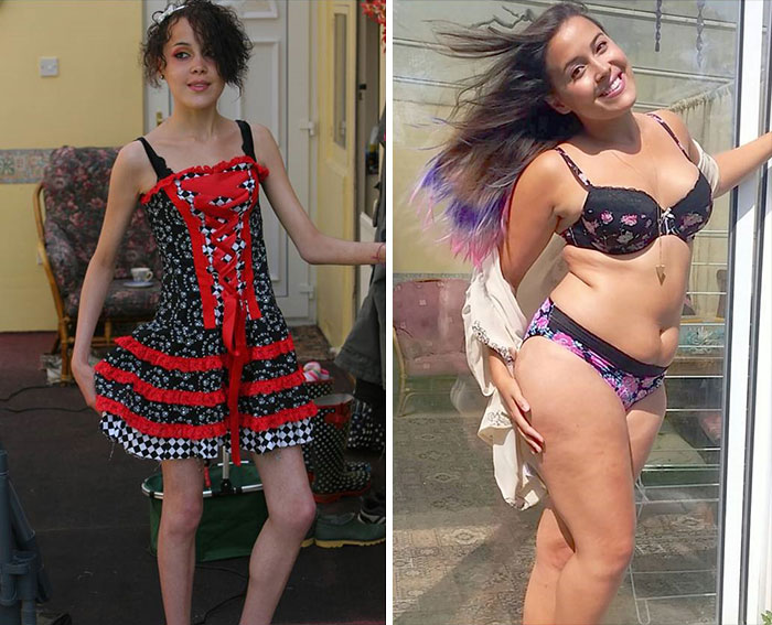 antes-despues-anorexia